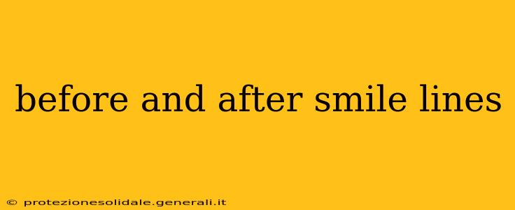 before and after smile lines