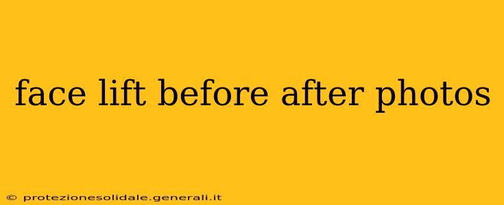 face lift before after photos