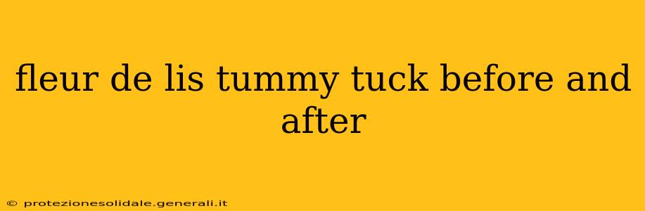 fleur de lis tummy tuck before and after