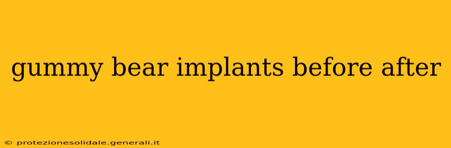 gummy bear implants before after