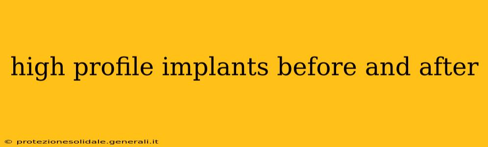 high profile implants before and after