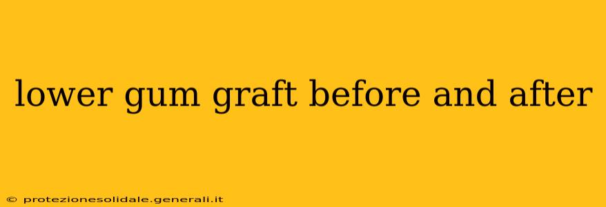 lower gum graft before and after