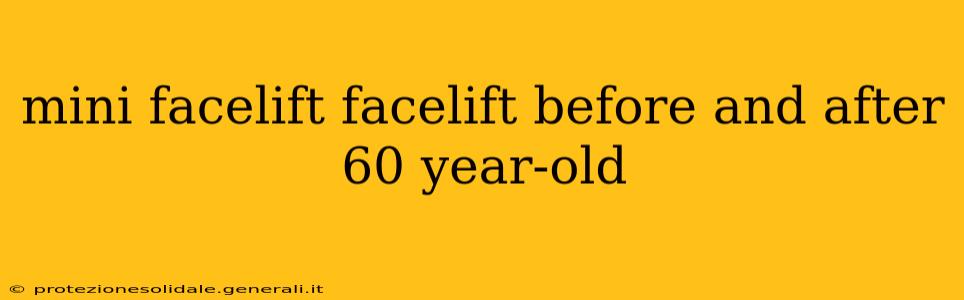 mini facelift facelift before and after 60 year-old