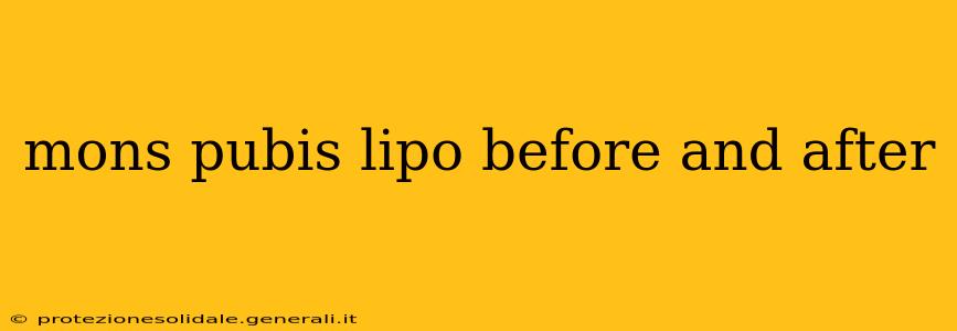 mons pubis lipo before and after