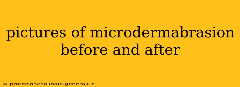 pictures of microdermabrasion before and after
