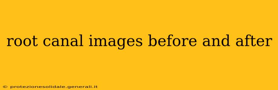 root canal images before and after