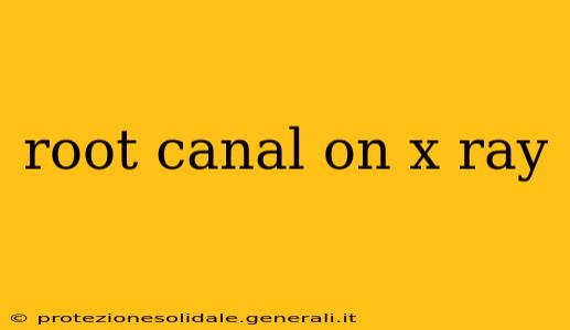 root canal on x ray
